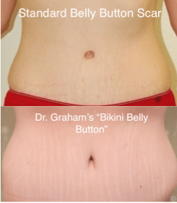 All About Belly Button After Tummy Tuck