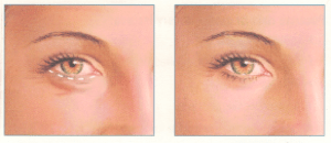 Eyelid Surgery