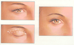 Eyelid Surgery