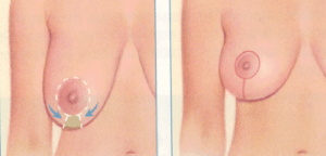 Breast Lift