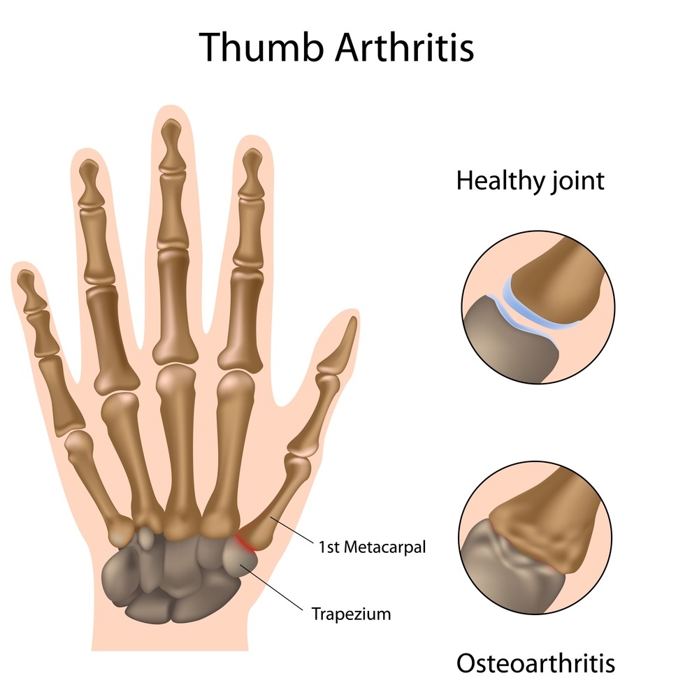 thumb-arthritis-graham-plastic-surgery-plastic-surgery-rochester-ny