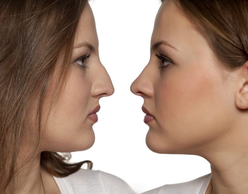 Why Choosing the Right Rhinoplasty Surgeon is Important