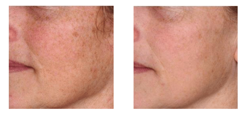 Laser Skin Resurfacing