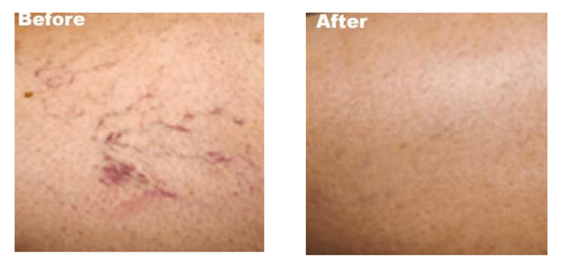 Laser Vein Treatment