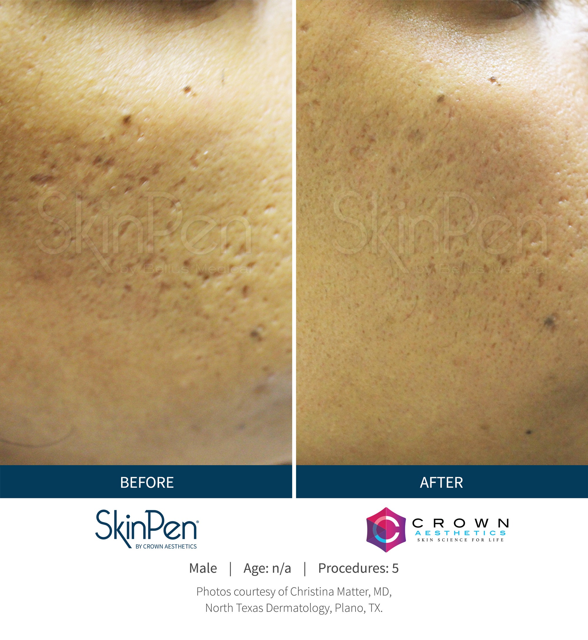 SkinPen® Microneedling Graham Plastic Surgery