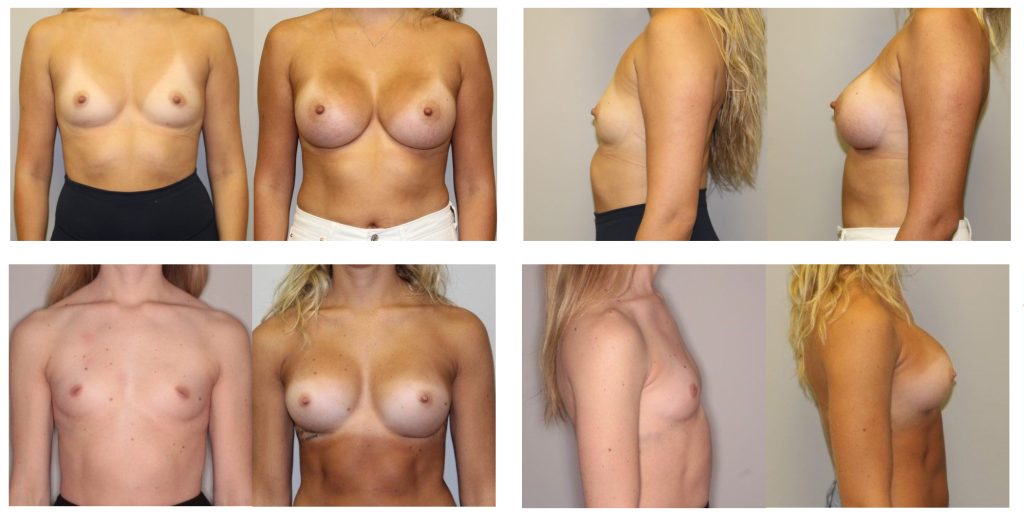 Breast Augmentation Plastic Surgery Before And After Photos