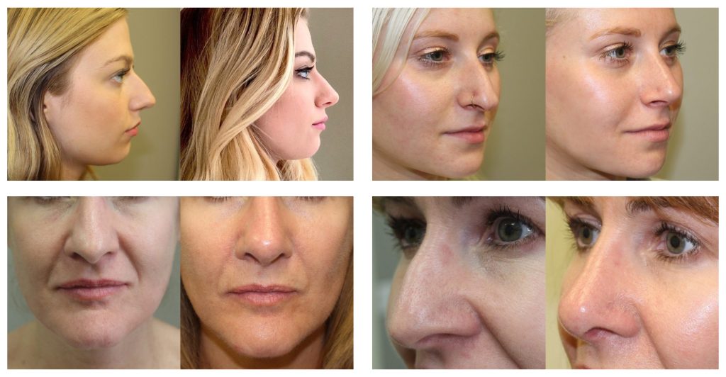 Rhinoplasty (Nose Surgery) Before And After Photos