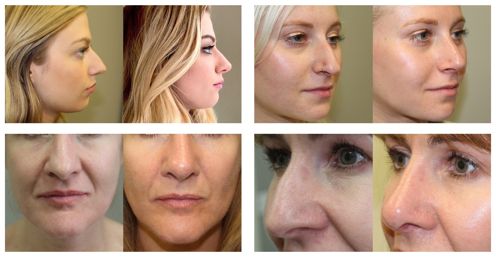 Rhinoplasty Nose Plastic Surgery Before After Photos Rochester