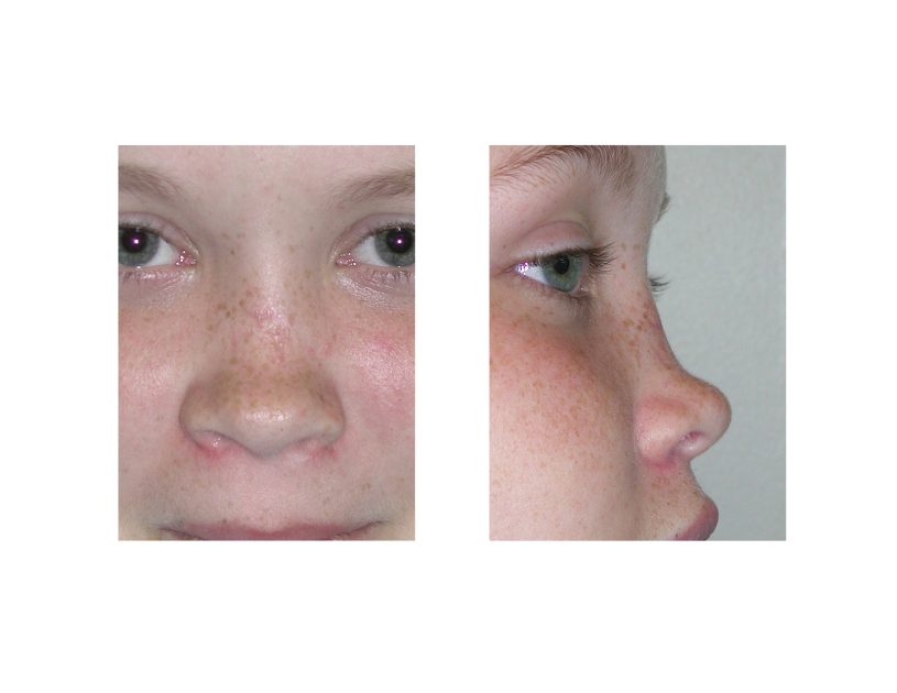 What is A Saddle Nose Deformity in Rhinoplasty?