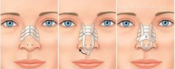 Is Taping After Rhinoplasty Helpful?
